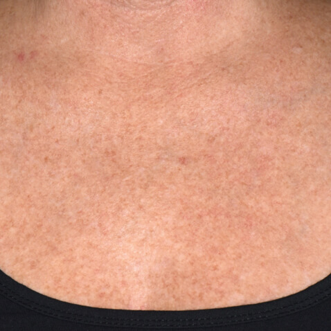 Lutronic DermaV - AFTER Dr. Suzanne Kilmer