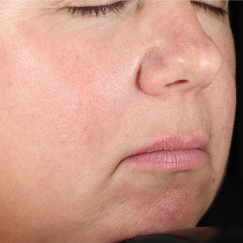 Lutronic DermaV BEFORE Dr. Eric Bernstein