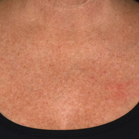 Lutronic DermaV - BEFORE Dr. Suzanne Kilmer