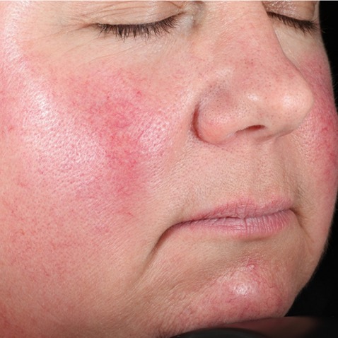 Lutronic DermaV BEFORE Dr. Eric Bernstein