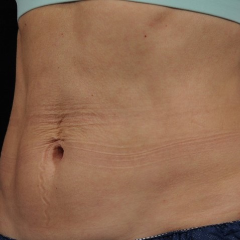 Accufit B&A - AFTER_Lutronic Research Clinic
