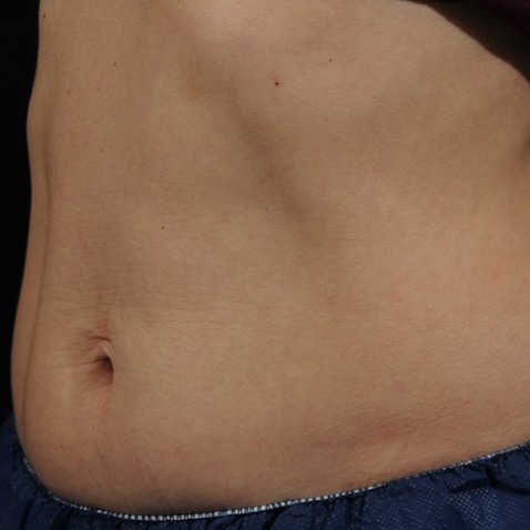Accufit_B&A - BEFORE Lutronic Research Clinic