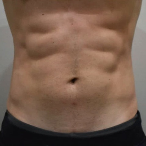 Accufit B&A - AFTER Warsaw Body Sculpting