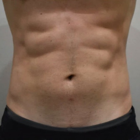 Accufit B&A - AFTER Warsaw Body Sculpting