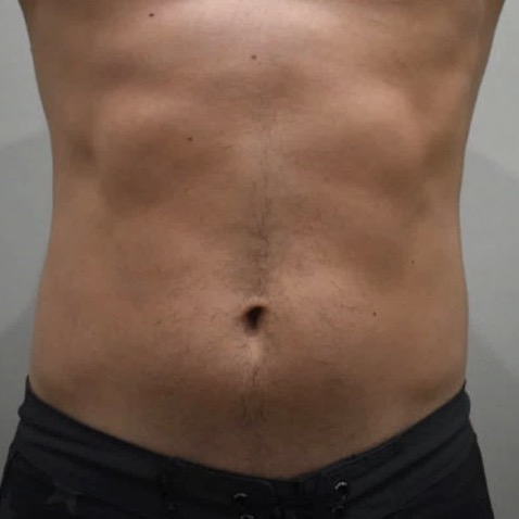 Accufit B&A - BEFORE Warsaw Body Sculpting