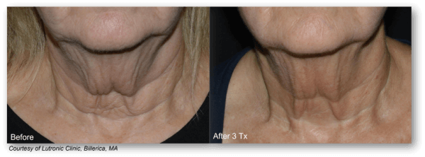 Before and after images of Turkey Neck treatment with Lutronic Genius