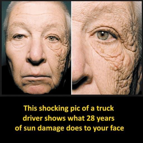 Sun damage after 28 years of truck driving