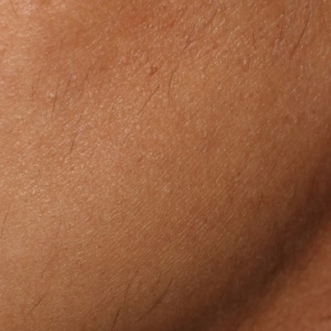 Clarity ll B&A Extra Fine Hair Removal - After