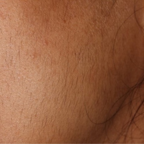 Clarity ll B&A Extra Fine Hair Removal - Before