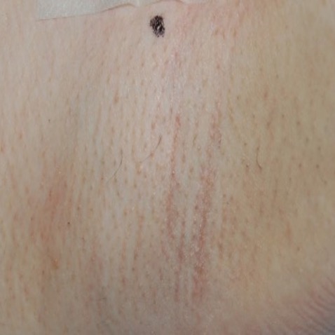 Lutronic Clarity ll - B&A Hair Removal - After