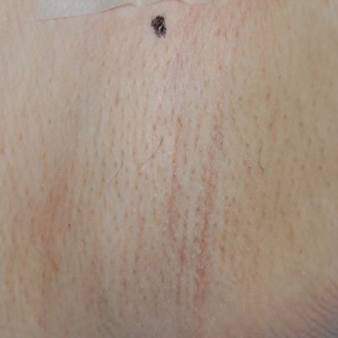 Lutronic Clarity ll - B&A Hair Removal - After