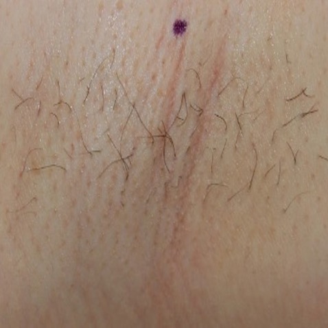 Lutronic Clarity ll - B&A Hair Removal - Before