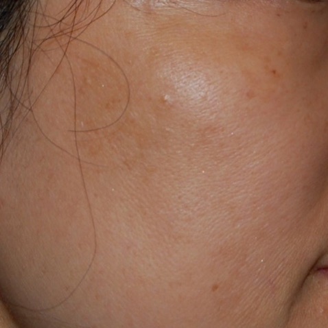 Before & Afters - courtesy Dr. J.H. Won, MD