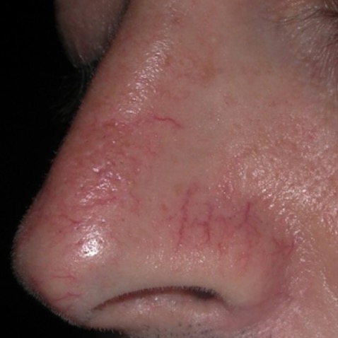 Before & Afters - Courtesy of David J. Friedman, MD
