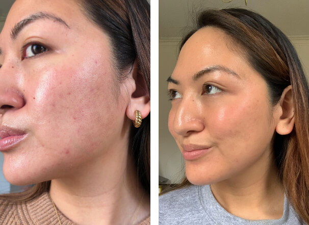 Genius acne scar treatment before and after