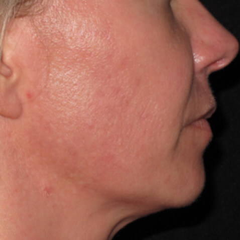 Genius Before & After - AFTER - courtesy of Dr. Deborah Manjoney