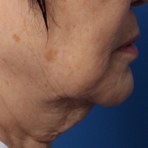 Genius Before & Afters- BEFORE - courtesy of Dr. JW Choi