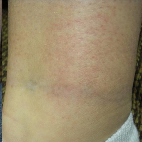 Before & Afters - Courtesy of Medermis Clinic