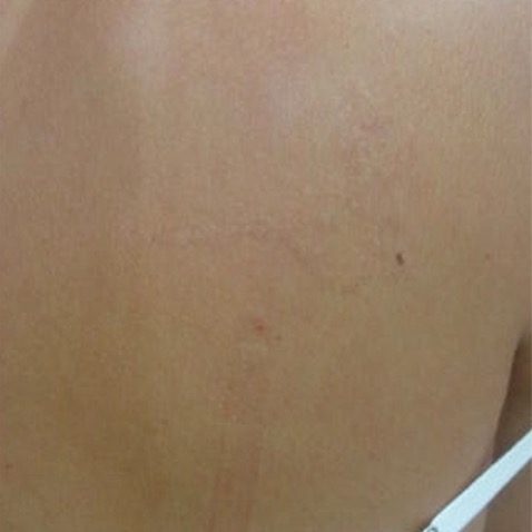 Before & Afters - Courtesy of Ivan Haded, MD