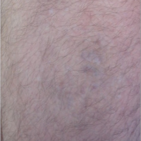 Before & Afters - Courtesy of Ivan Haded, MD