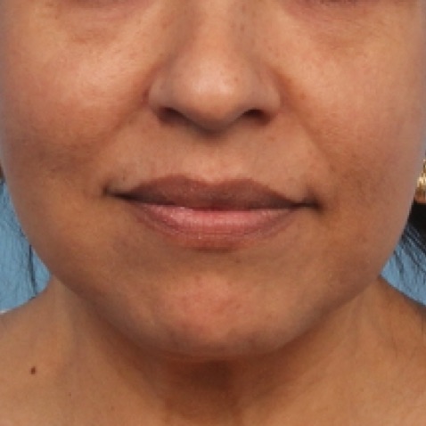 Before & Afters - Courtesy of Melanie Palm, MD, MBA