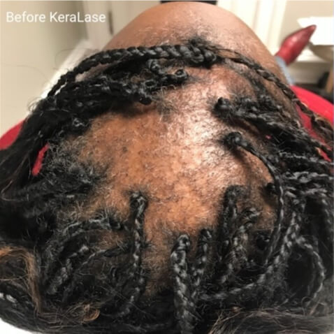KeraLase Before & Afters - courtesy of Jeanine Downie, MD