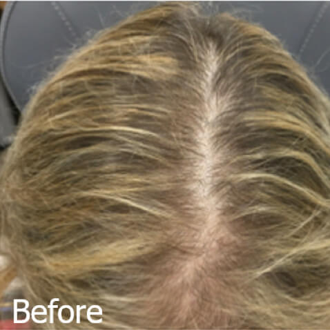 KeraLase Before & Afters - courtesy of Lani Doser, ​DNP, FNP-C