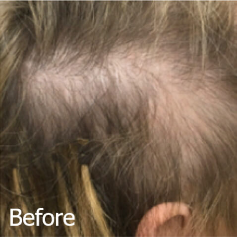KeraLase Before & Afters - courtesy of Lani Doser, ​DNP, FNP-C