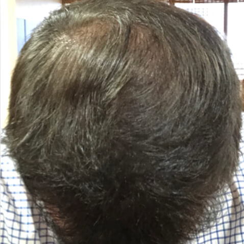 KeraLase Before & Afters - courtesy of Lutronic Research Clinic