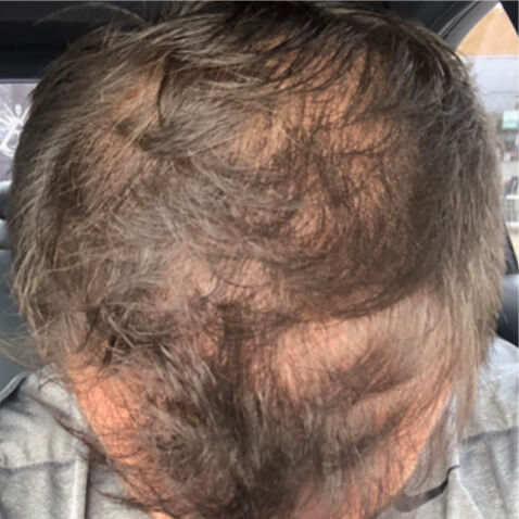 KeraLase Before & Afters - courtesy of Lutronic Research Clinic