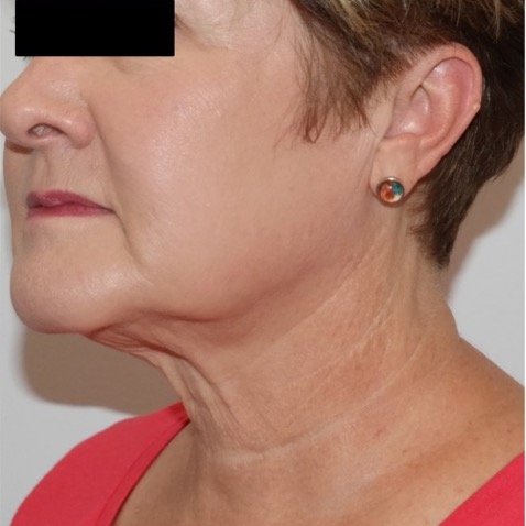 Before & Afters - Courtesy of Steven Weiner, MD