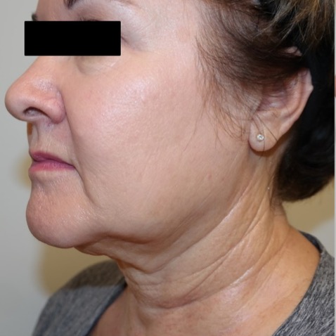 Before & Afters - Courtesy of Steven Weiner, MD