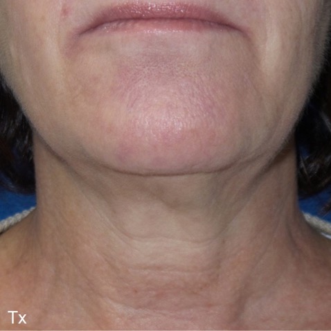 Before & Afters - Courtesy of Frank Barone, MD, FACS