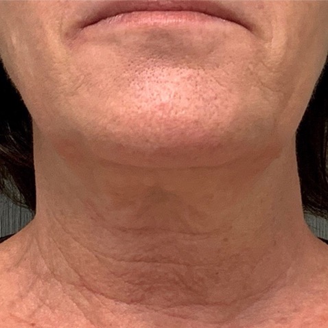 Before & Afters - Courtesy of Frank Barone, MD, FACS