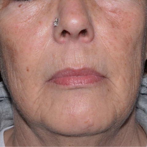 Before & Afters - Courtesy of Lutronic Research Clinic