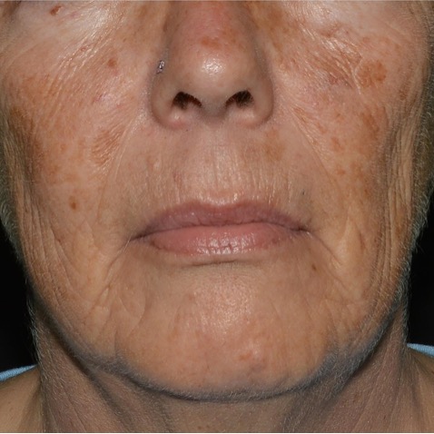 Before & Afters - Courtesy of Lutronic Research Clinic