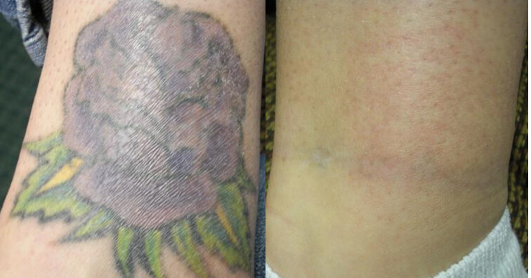 tattoo removal results after 8 treatments with Lutronic Hollywood Spectra