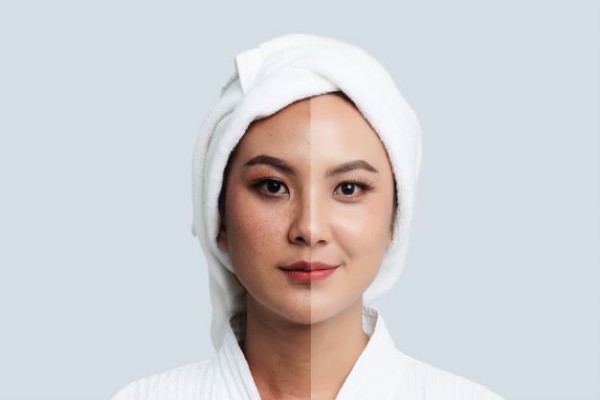 Asian woman with towel on head before and after laser treatment