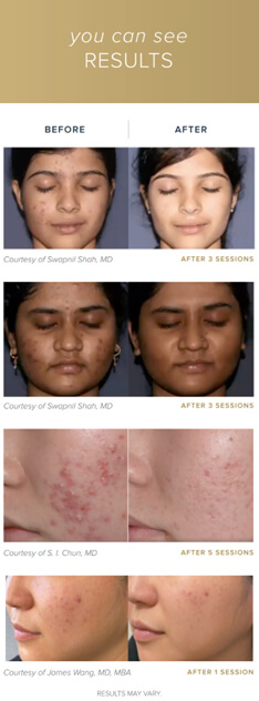 Hollywood Laser Peel - patient before and after pictures