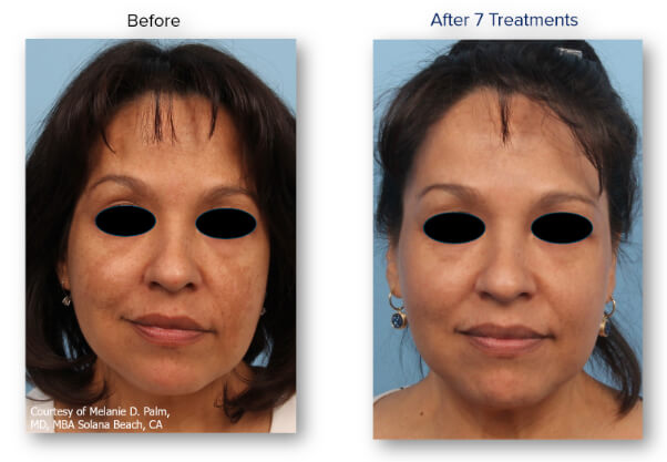 Before and after images of Lutronic Spectra melasma treatment