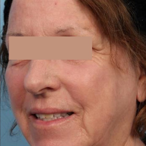 Before & Afters - Courtesy of Melanie Palm, MD, MBA