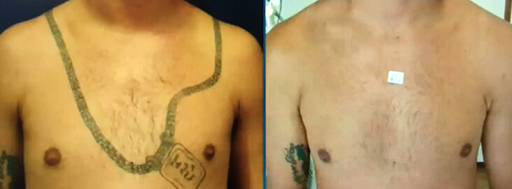 Results of chest tattoo removal after 8 treatments with Lutronic Hollywood Spectra