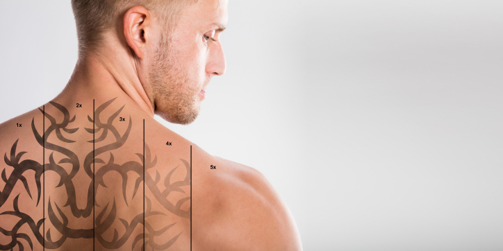 What is laser tattoo removal?