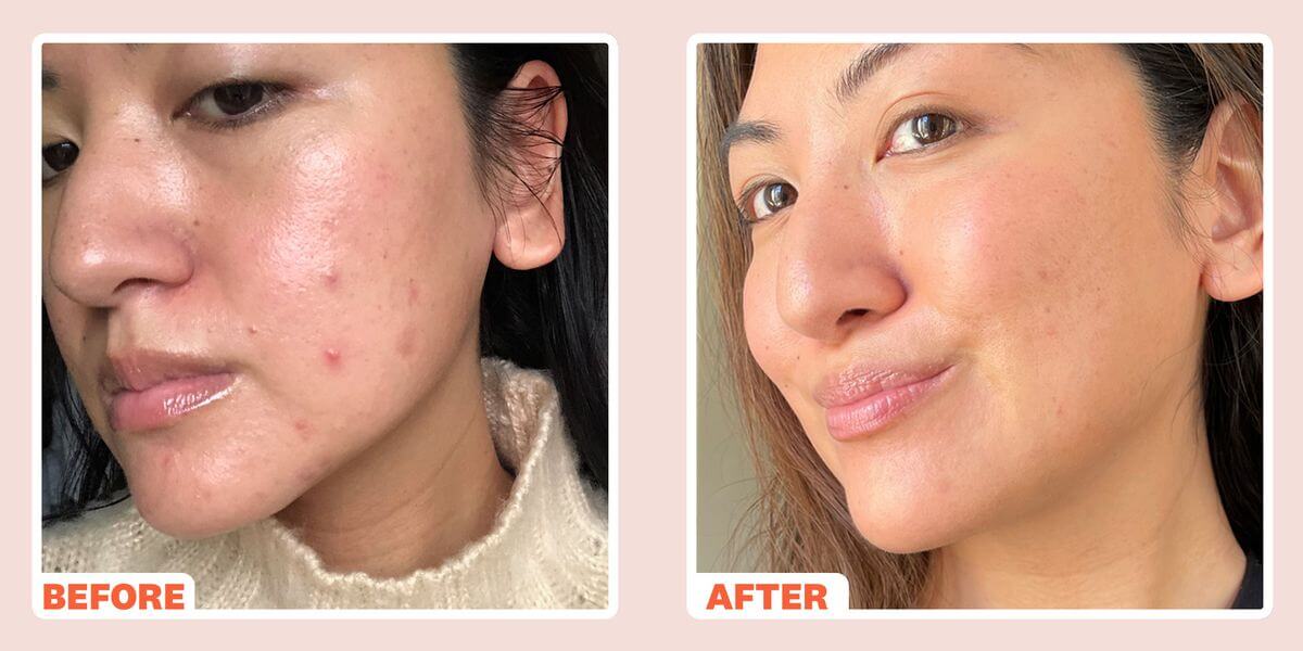 Women's Health Magazine article image of woman's face before and after Microneedling treatment for Acne Scars