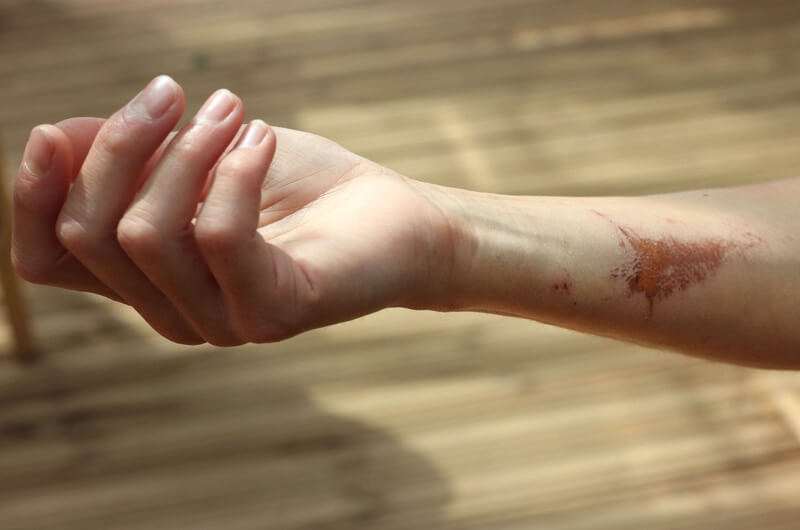 womans arm with scar
