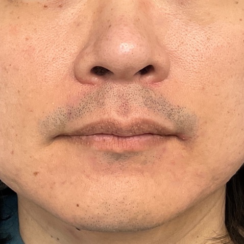 Before & Afters - Courtesy of James Wang, MD