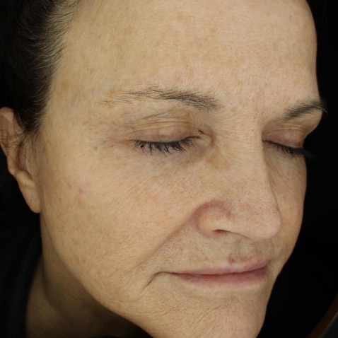 Before & Afters - Courtesy of Omar Ibrahimi, MD.