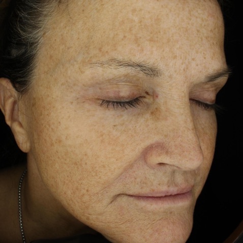Before & Afters - Courtesy of Omar Ibrahimi, MD.