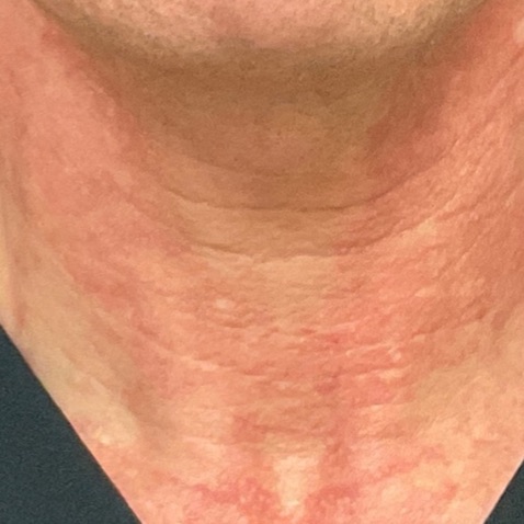 Before & Afters - Courtesy of Suzanne Kilmer, MD.