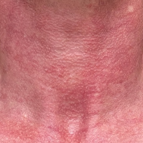 Before & Afters - Courtesy of Suzanne Kilmer, MD.